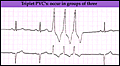 ecg_tri_pvc.gif